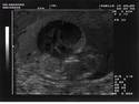 Echography Foetus